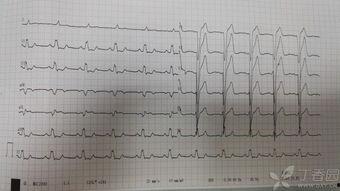 心电图吃瓜视频,揭秘心电图背后的趣味与知识 第2张 心电图吃瓜视频,揭秘心电图背后的趣味与知识 第2张