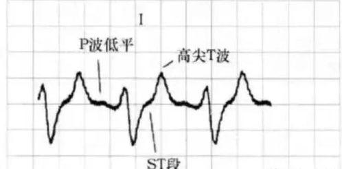 心电图吃瓜视频,揭秘心电图背后的趣味与知识 第3张 心电图吃瓜视频,揭秘心电图背后的趣味与知识 第3张